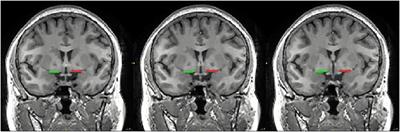 Altered Cortical Cholinergic Network in Parkinson’s Disease at Different Stage: A Resting-State fMRI Study